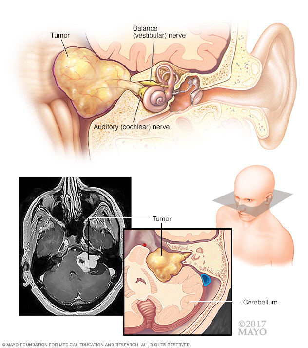 Acoustic neuroma, a benign tumor on the nerves leading from the inner ear to the brain