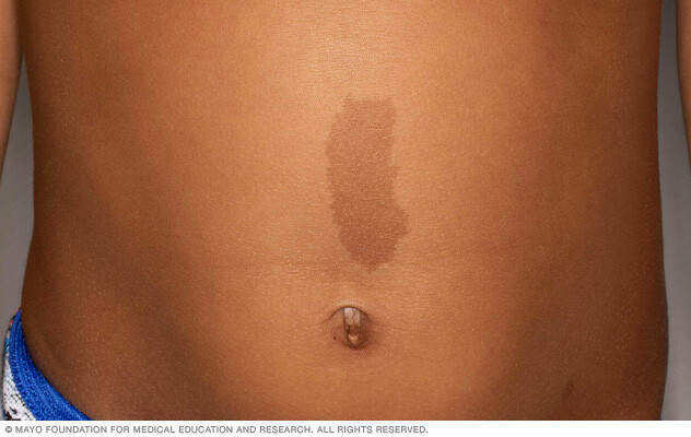 Image of cafe au lait birthmark