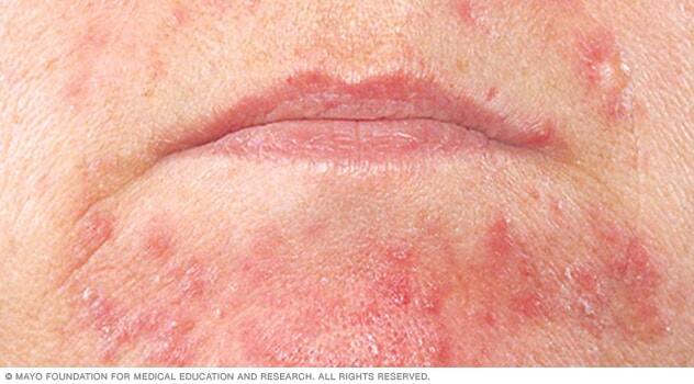 Perioral dermatitis