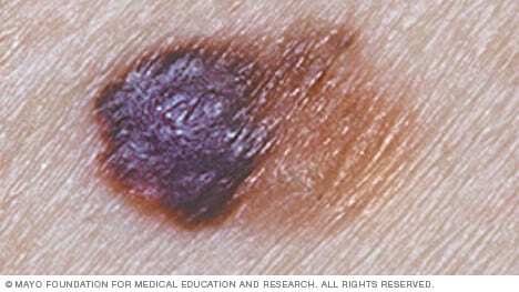 Melanoma with asymmetrical shape