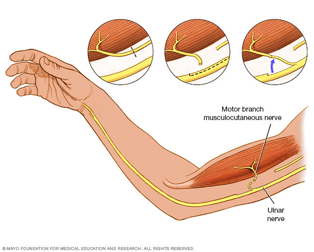 Nerve transfer