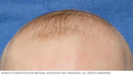 A newborn's head