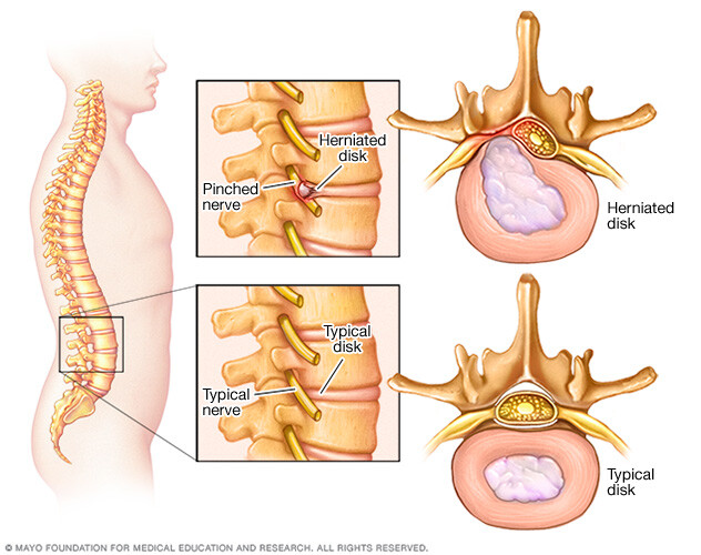 Image showing pinched nerve in spine