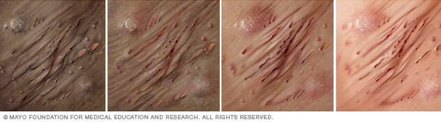 Hidradenitis suppurativa on four different skin colors.