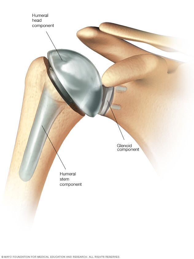 Anatomic total shoulder replacement