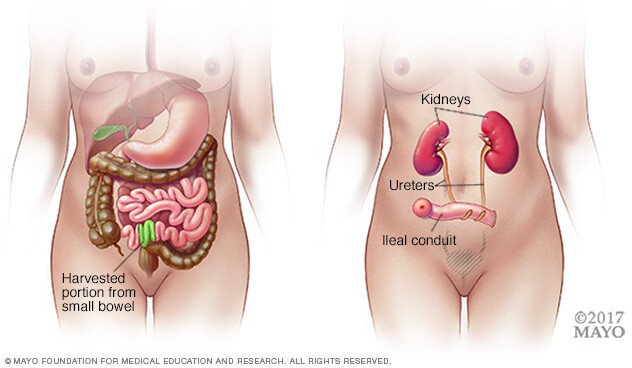 Part of small intestine used for ileal conduit surgery