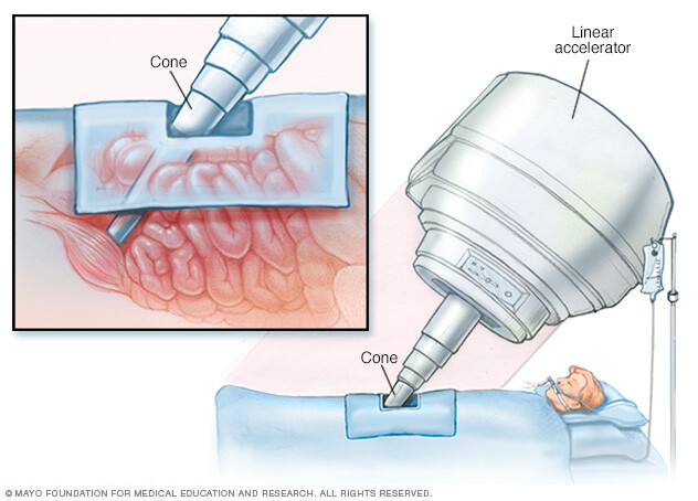 Device delivering radiation therapy during surgery