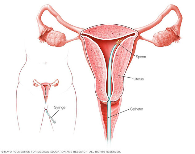 How intrauterine insemination is done