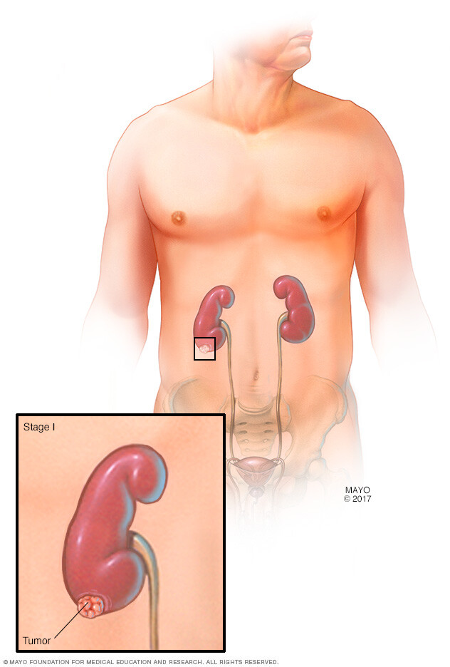 A kidney with a stage 1 kidney cancer