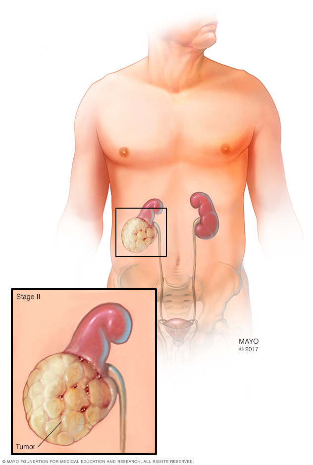 A kidney with a stage 2 kidney cancer