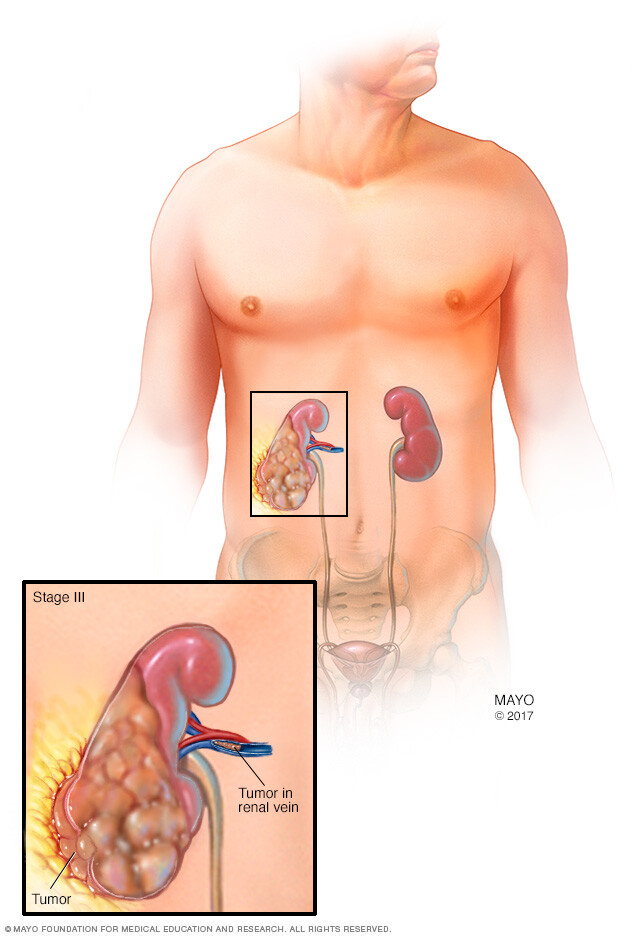 A kidney with a stage 3 kidney cancer