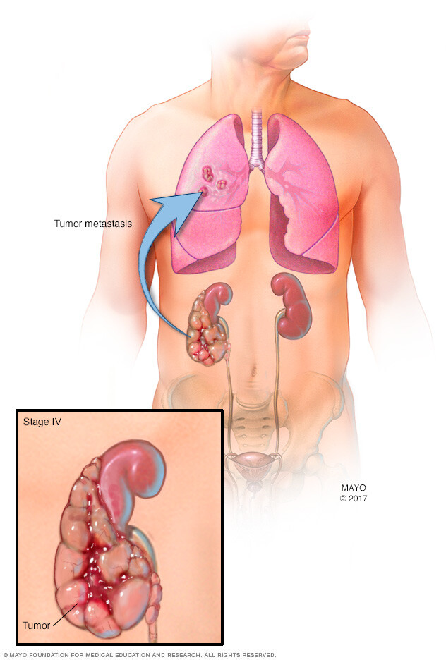 A stage 4 kidney cancer that has spread to the lungs