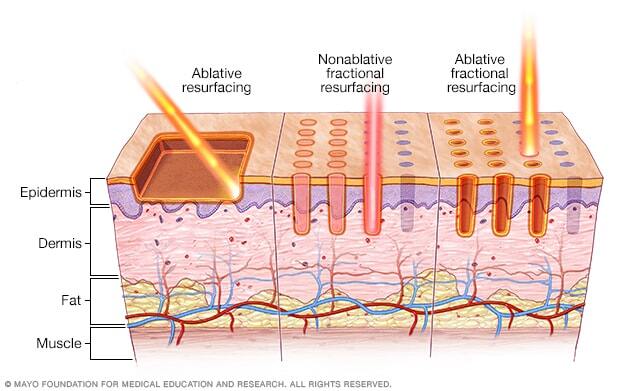 Types of laser resurfacing