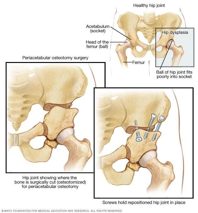 Periacetabular osteotomy