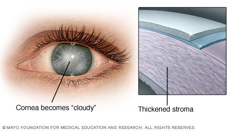 Fuchs dystrophy