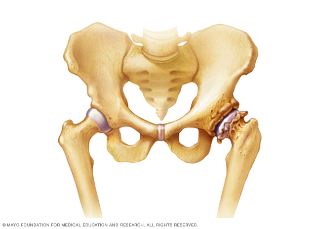 Osteoarthritis of the hip