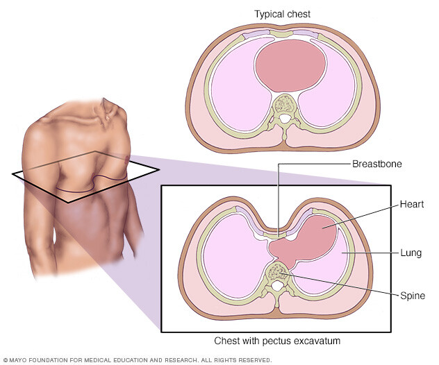 Breastbone depression 