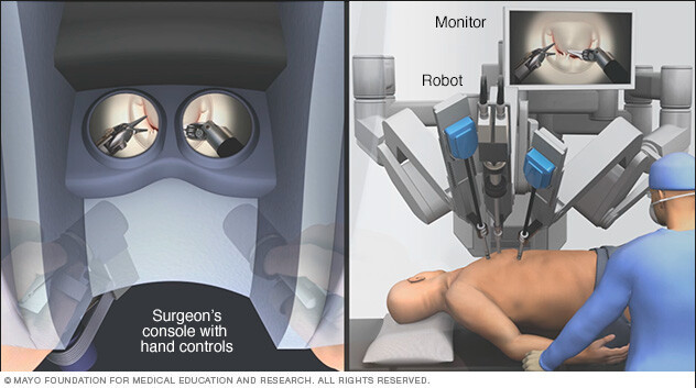 Minimally invasive heart surgery