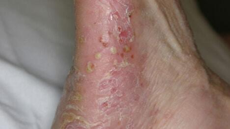 Pustular psoriasis