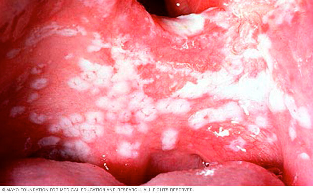 Photograph showing patches of oral thrush on the tongue.