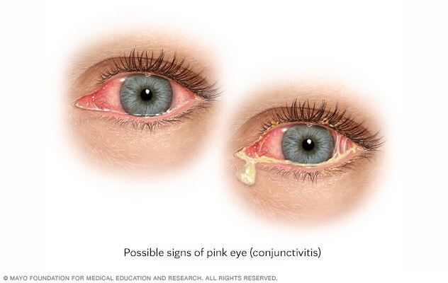 Pink eye (conjunctivitis)