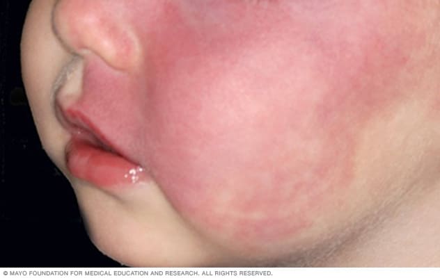 Image of port-wine stain birthmark on the cheek