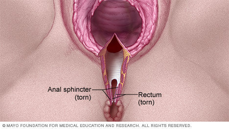 Illustration of a fourth-degree vaginal tear