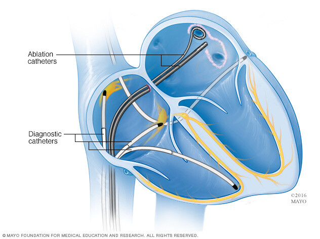 A type of cardiac ablation called pulmonary vein isolation