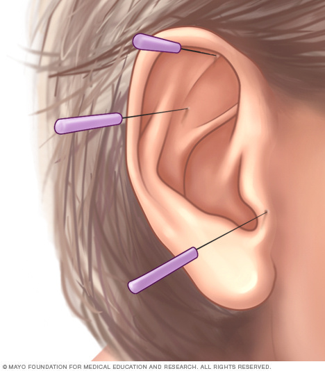 Ear acupuncture