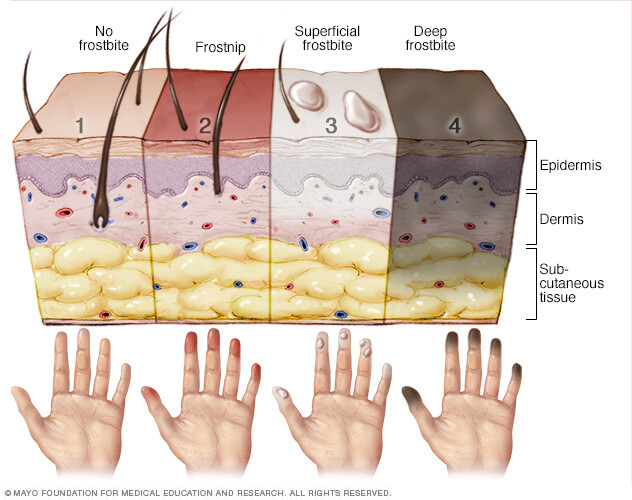 Stages of frostbite