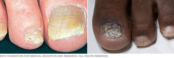 Nail fungus