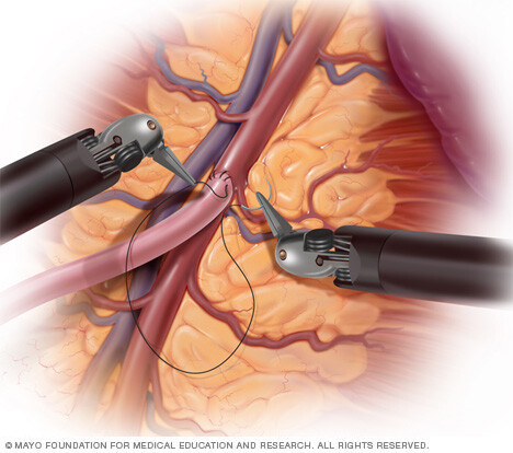 Robot-assisted heart surgery