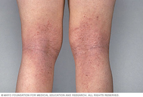 Atopic dermatitis on the legs