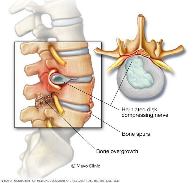 Bone spurs and herniated disk in the spine