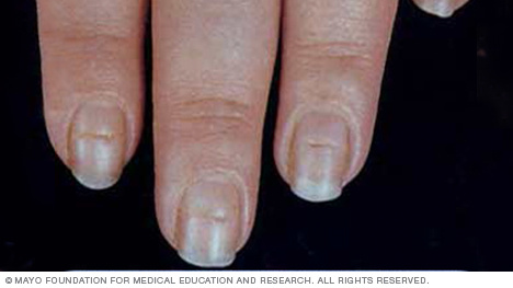 An example of fingernails with Beau's lines