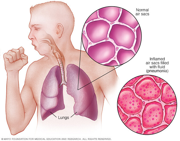 Lungs with pneumonia